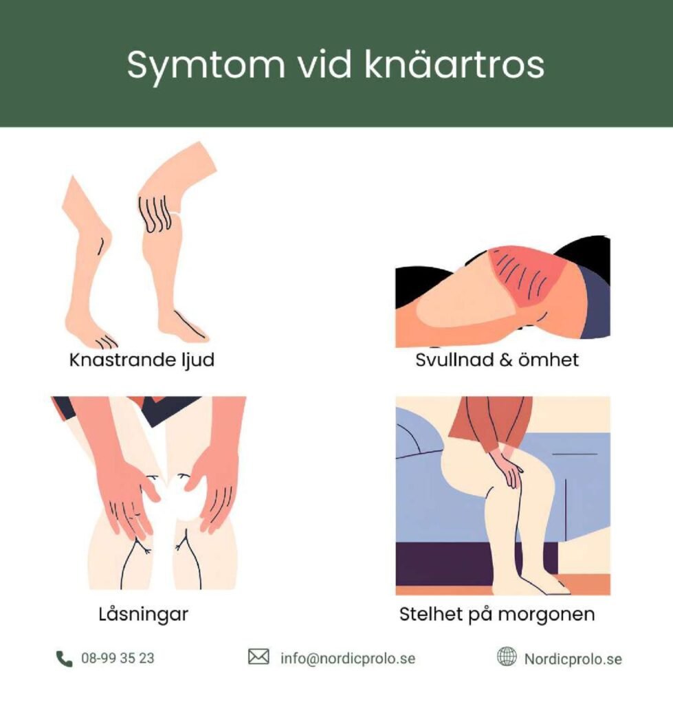 symptom av artros, knäartros , stelhet . smärta , låsningar 