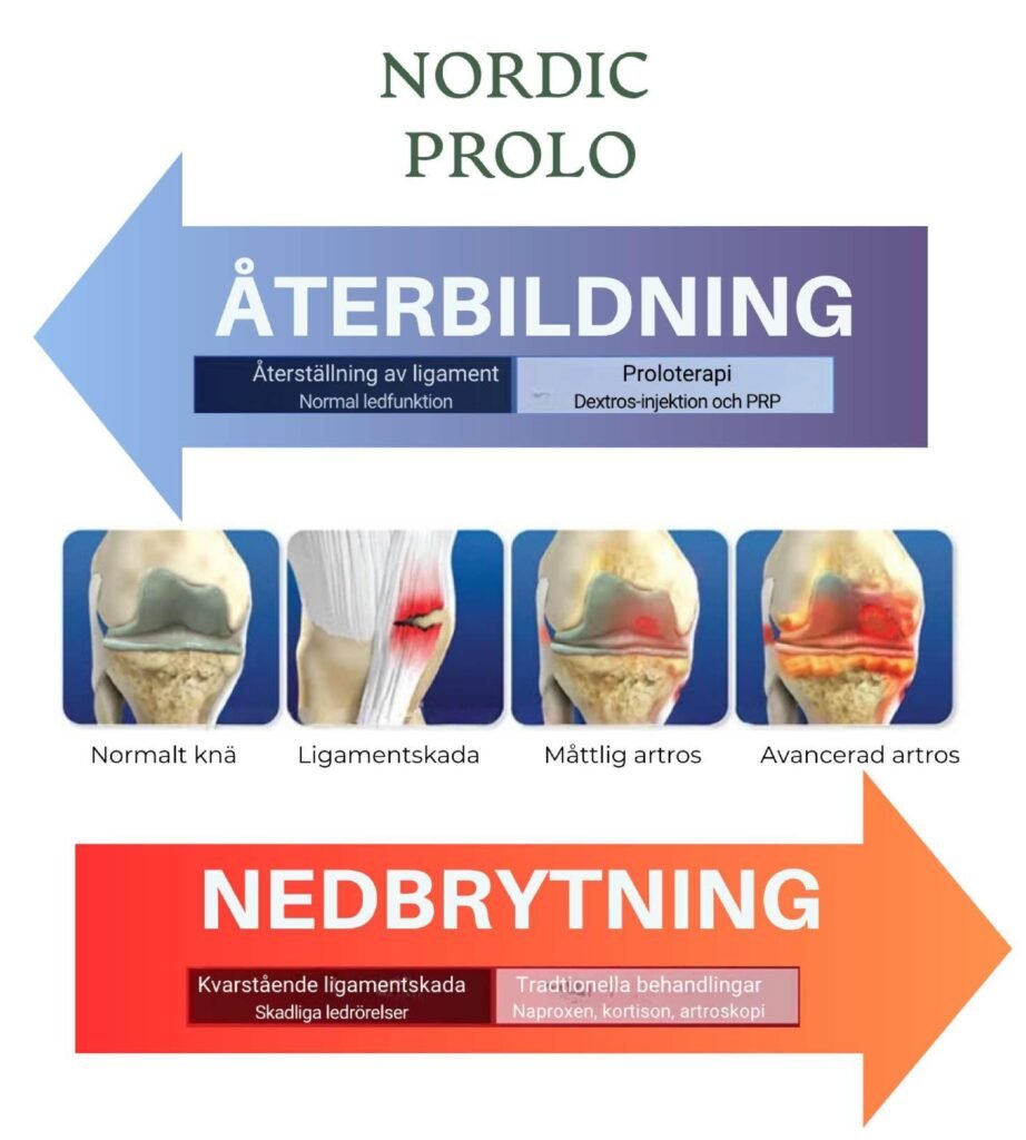 en bild av knä med artros och hur PRP kan hjälpa 